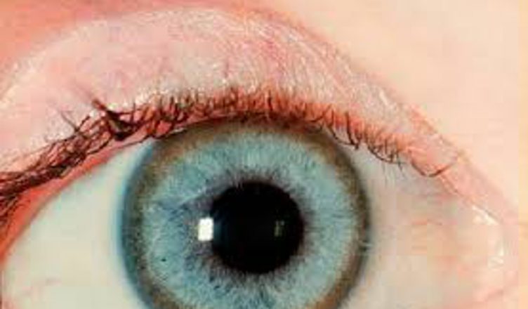 Olho com doença de Wilson