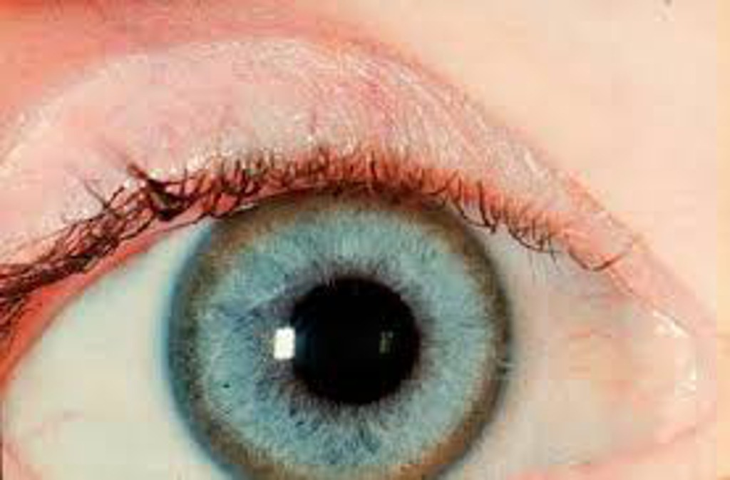 Olho com doença de Wilson